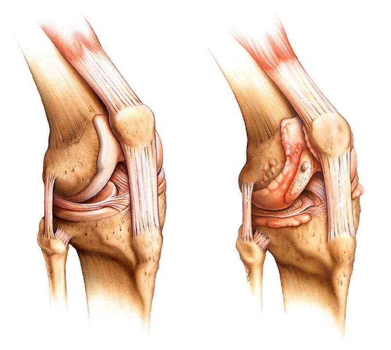 Articulación sana (izquierda) y articulación artrítica (derecha)
