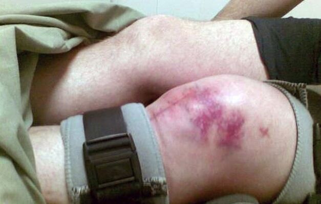 Las causas de la artrosis de la articulación de la rodilla