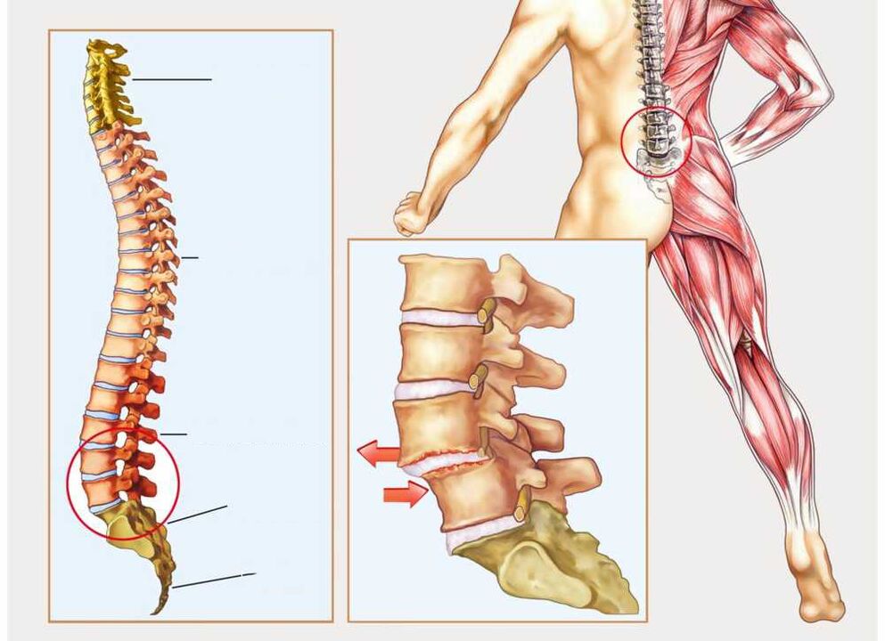 columna vertebral sana y enferma