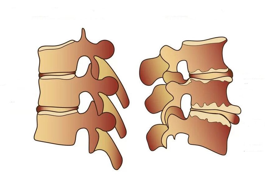 columna vertebral sana y enferma