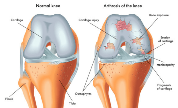 Articulación normal y afectada por la osteoartritis